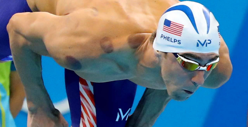 Michael Phelps showing circular cupping marks on his back