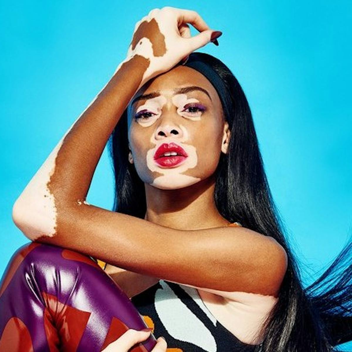 Winnie Harlow in a contextual photograph: Inline contextual photo; not tattoo evidence; not tattoo evidence